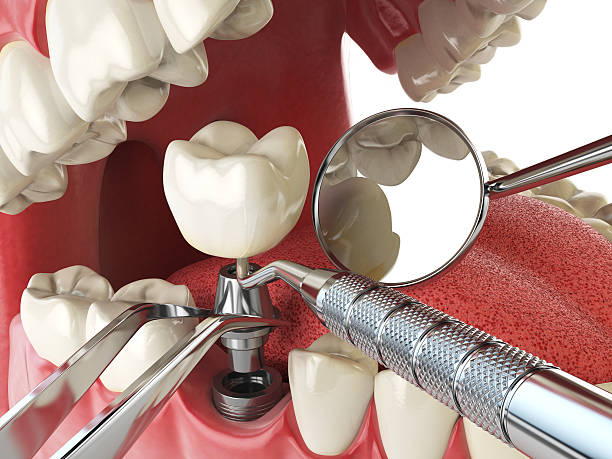 Best Emergency Root Canal Treatment in West Point, MS